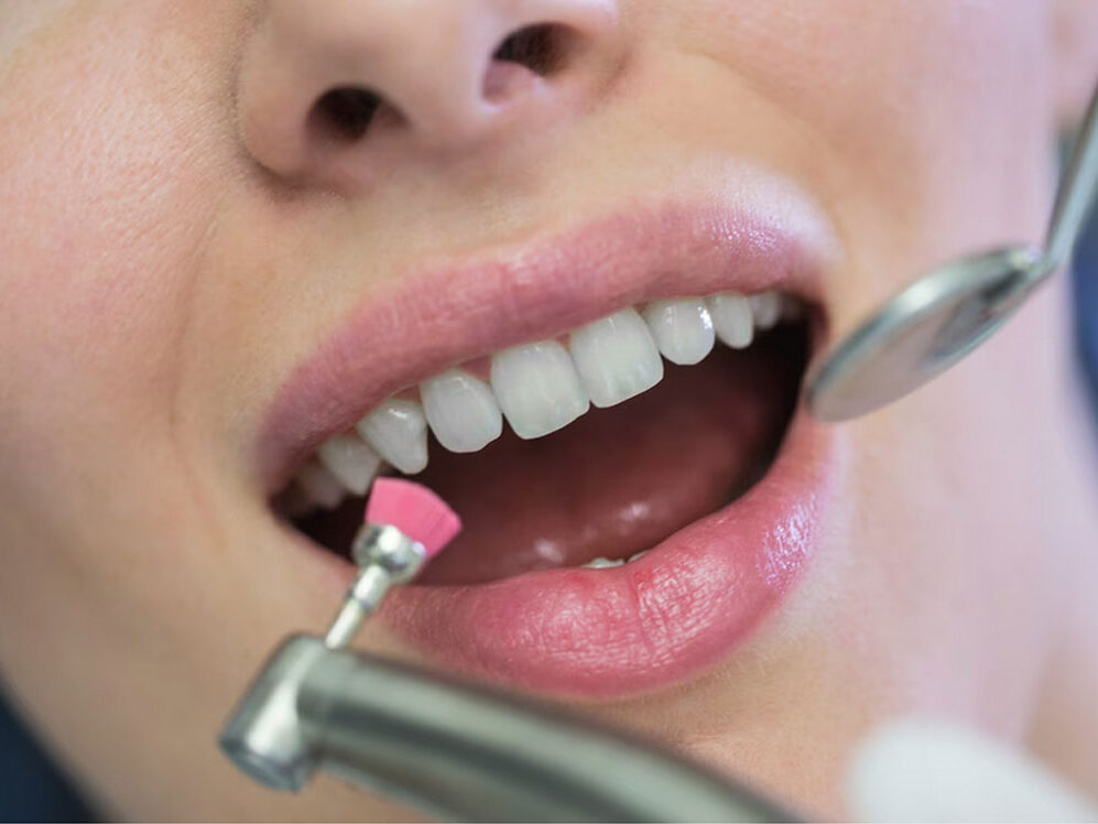 Dentap - Clínica Dentária - Higiene dental